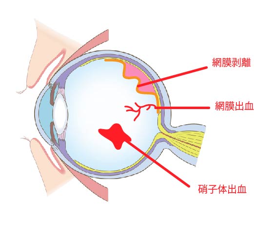 糖尿病網膜症について